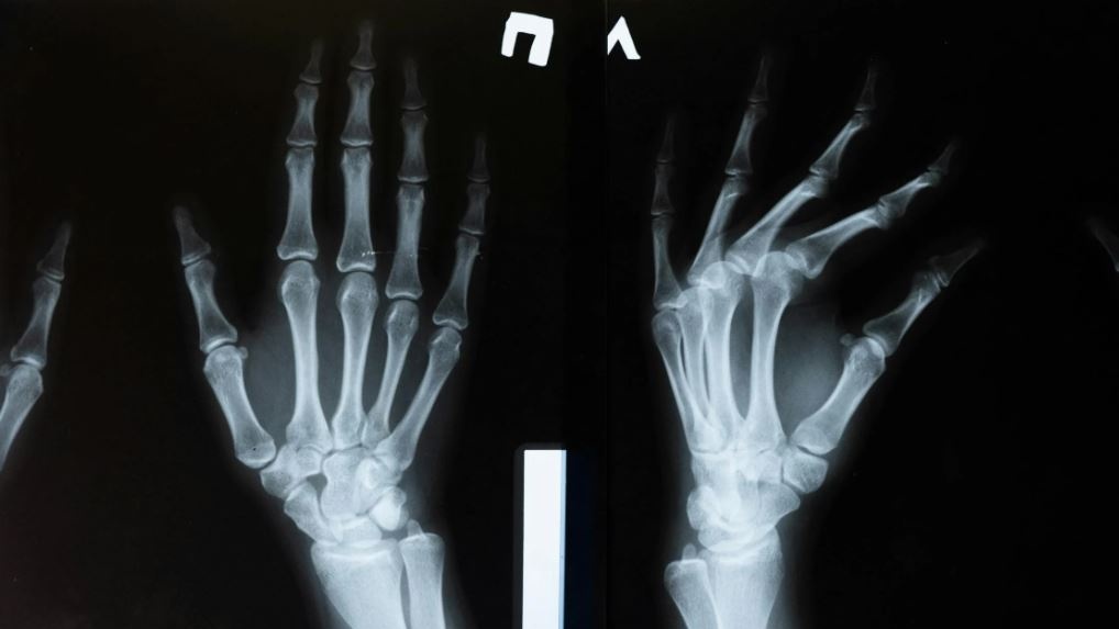 Osteoporosi: nel mondo 500 milioni potrebbero soffrirne, ma non hanno una diagnosi