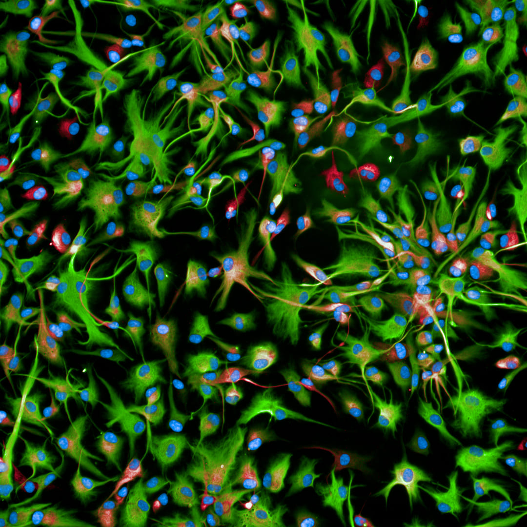 TUMORI CEREBRALI NEI BAMBINI, UNA TERAPIA SPERIMENTALE ACCRESCE L’ASPETTATIVA DI VITA