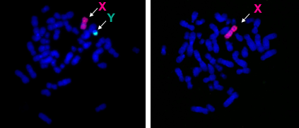 COME IL CROMOSOMA Y SAREBBE CONNESSO A MALATTIE E FORMAZIONE DI TUMORI