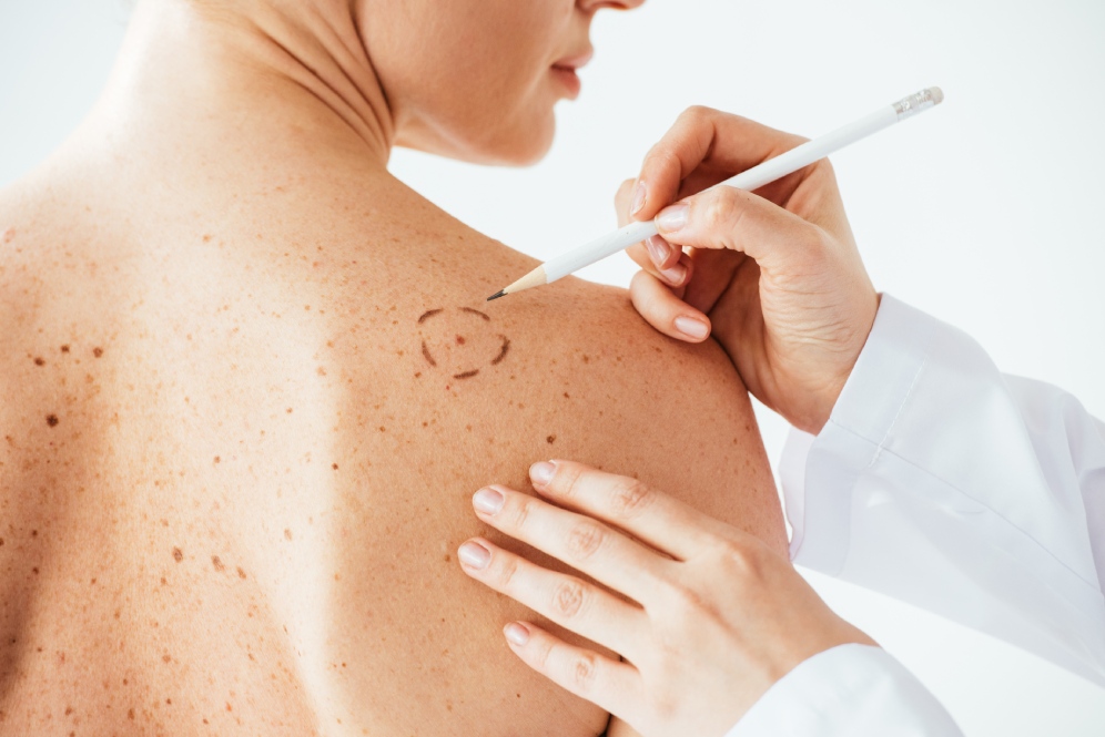 I melanomi si sviluppano in aree diverse tra uomo e donna