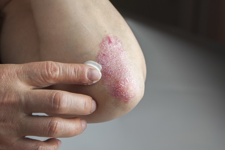Il legame tra psoriasi e cibi ultra-processati