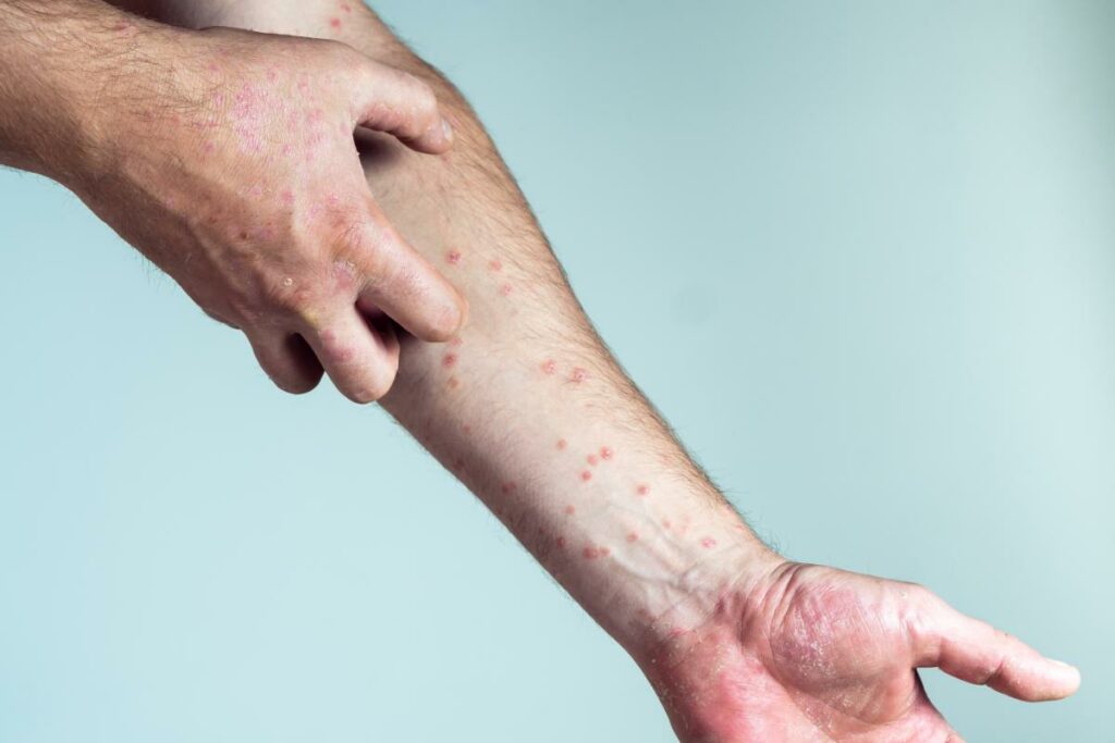 Giornata Mondiale del Lupus, il ruolo della 'Lupus Unit'