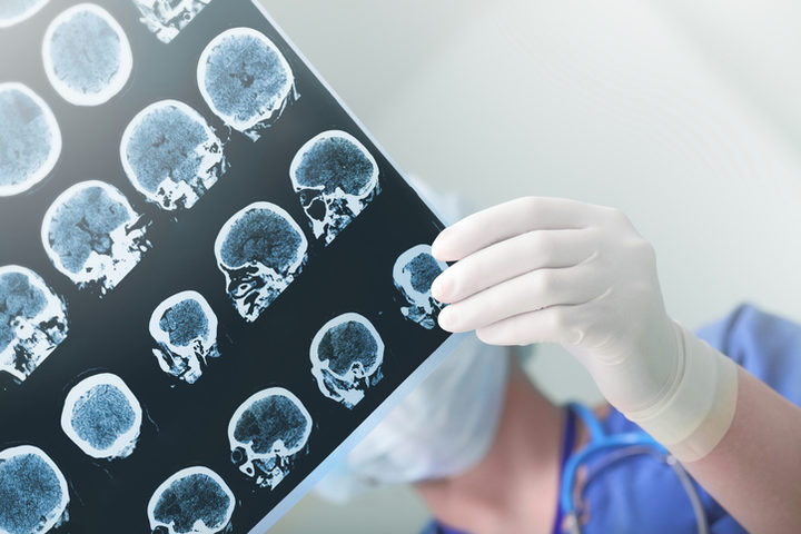 Il litio aiuta a combattere l'Alzheimer: lo sostiene uno studio
