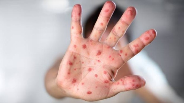 Morbillo: rallenta l'epidemia negli Usa, ma si teme una recrudescenza con l'inizio delle scuole